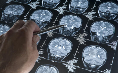 Glioblastoma in 15-39 year-olds: 230% increase in 20 years!